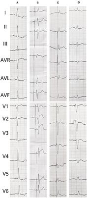 Case report: What course to follow when left bundle branch pacing encounters acute myocardial infarction?